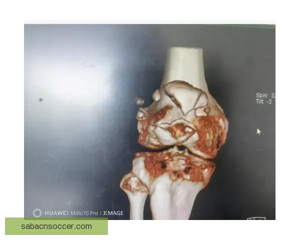 穆迪受伤可能影响下赛季复出队医称髌骨肌腱问题严重